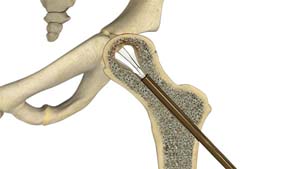 Core Decompression for Avascular Necrosis of the Hip