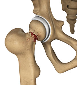 Hip Injuries